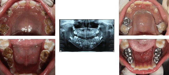 Full-mouth-Rehabilitation