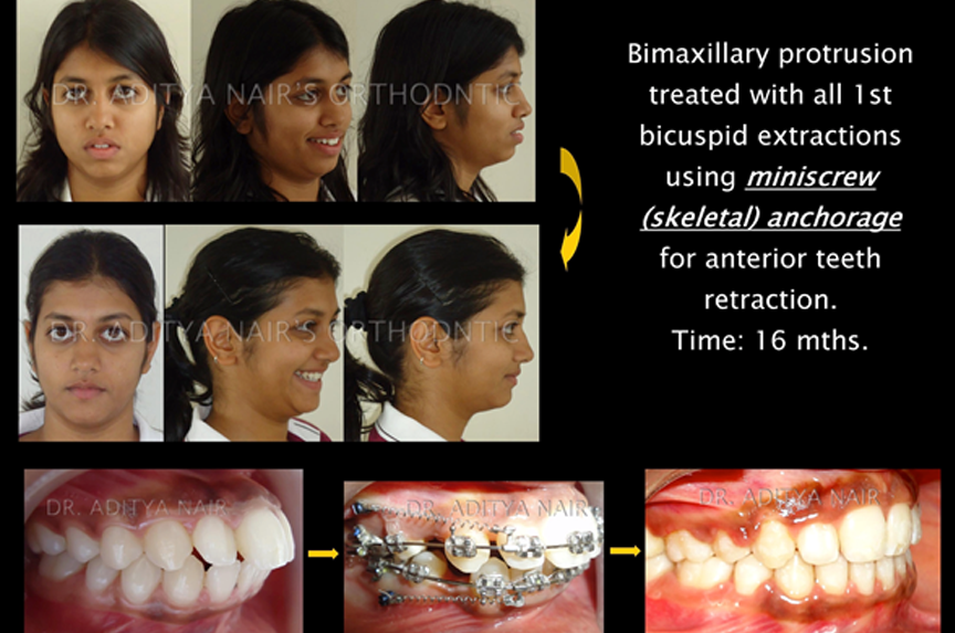 Metal-or-Ceramic-Braces