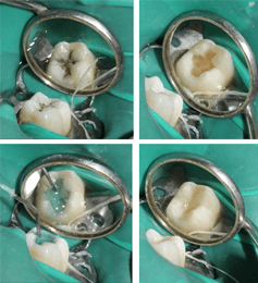 Pit-and-Fissure-Sealants