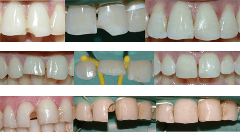 Tooth-coloured-Fillings